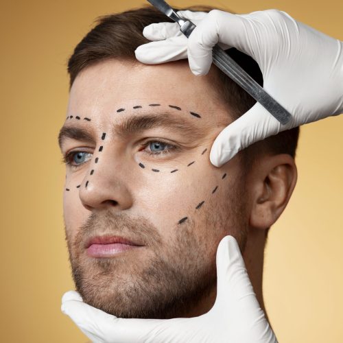 masculinización facial con prótesis